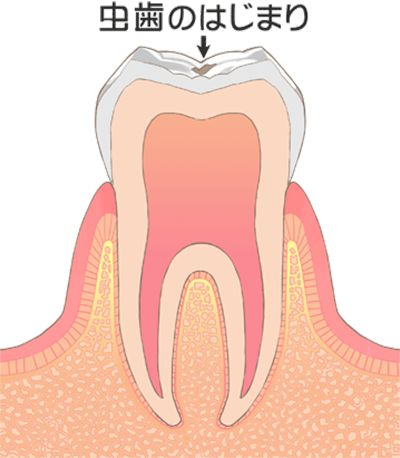 虫歯の治療