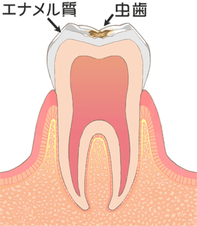 虫歯の治療