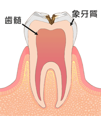 虫歯の治療