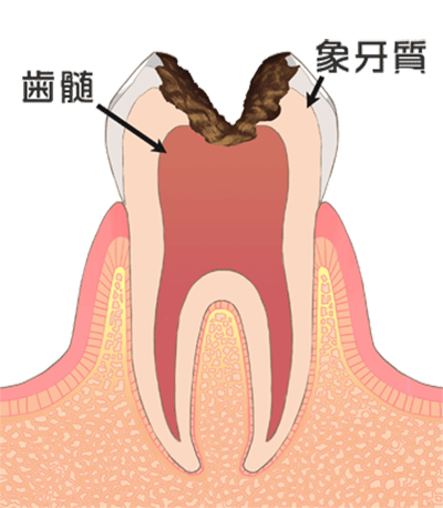 虫歯の治療