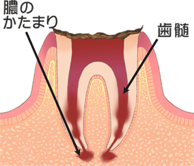 虫歯の治療