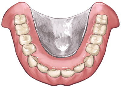 金属の入れ歯