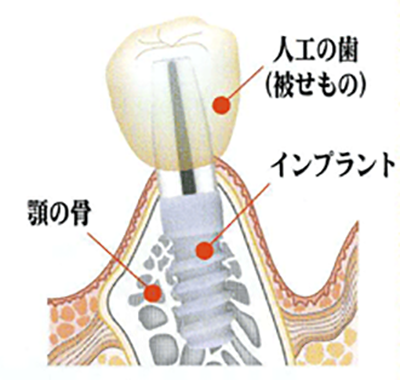 インプラント治療なら